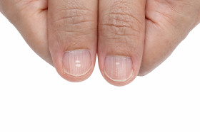 What Causes White Spots on Fingernails? | Wonderopolis
